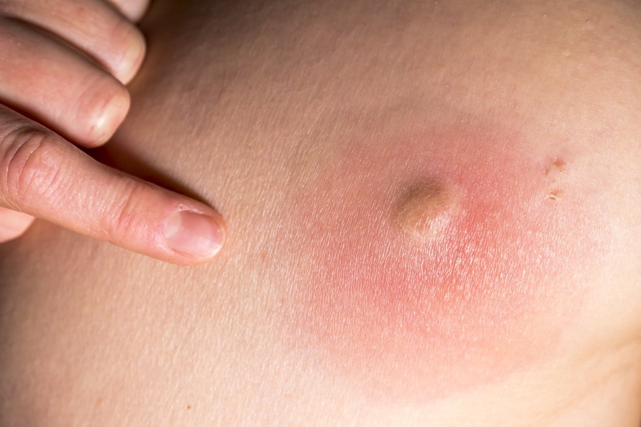 Cara Merawat Bisul yang Belum Pecah