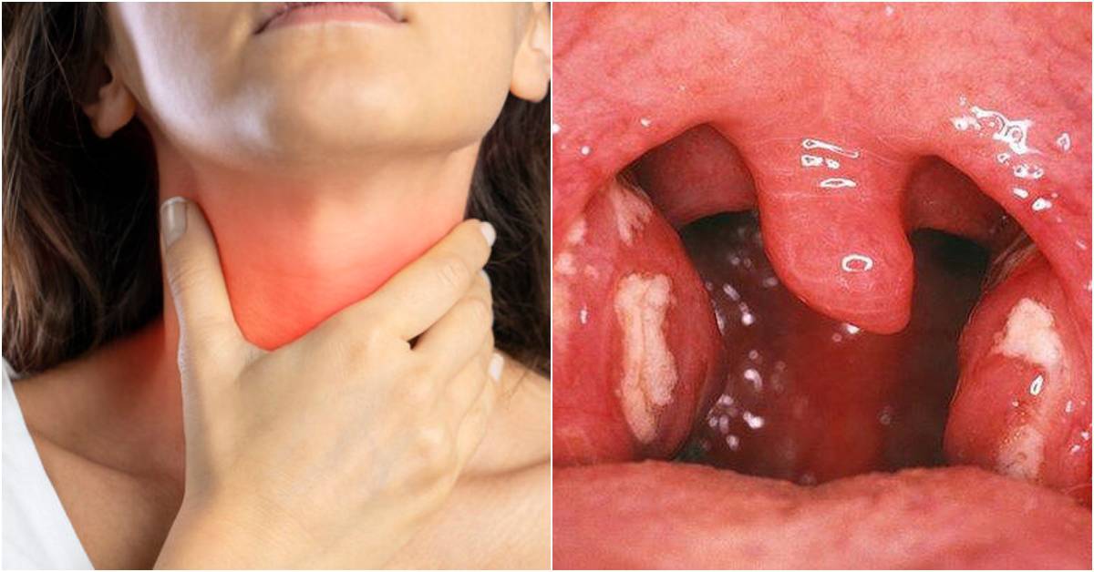 Cara Merawat Tonsil Bengkak